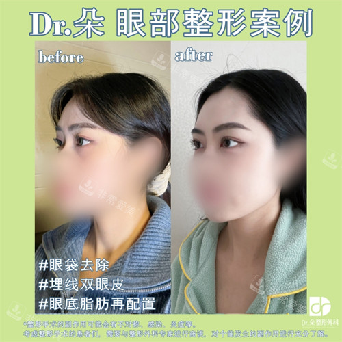 韩国朵医院双眼皮眼底脂肪重置前后对比侧脸照