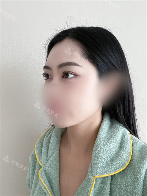眼底脂肪再配置術(shù)后圖 眼底脂肪再配置術(shù)后圖