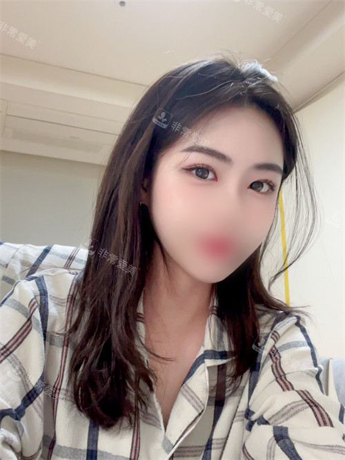雙眼皮眼底脂肪重置療效圖 雙眼皮眼底脂肪重置療效圖