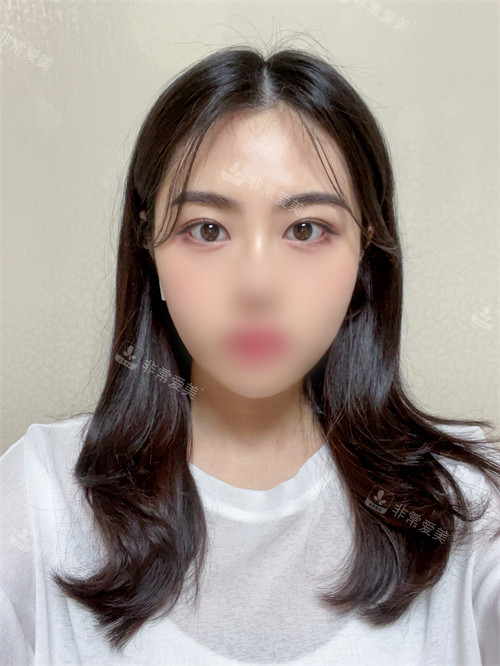 雙眼皮眼底脂肪重置術(shù)后美照 雙眼皮眼底脂肪重置術(shù)后美照