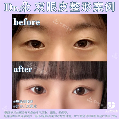 韩国dr.朵整形医院双眼皮手术对比