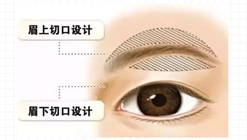 提眉術(shù)切口位置 提眉術(shù)切口位置
