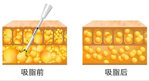 吸脂前后脂肪吸脂大小及分布示意圖