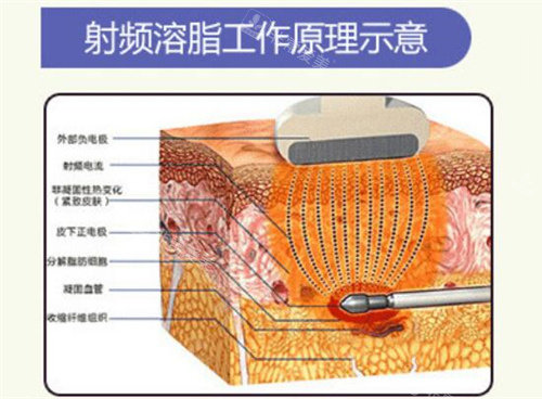 射频溶脂工作原理示意图