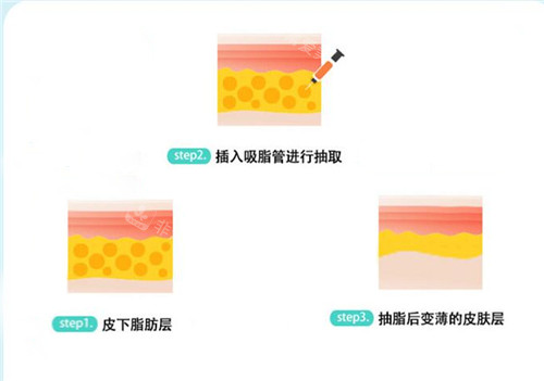 吸脂原理示意圖