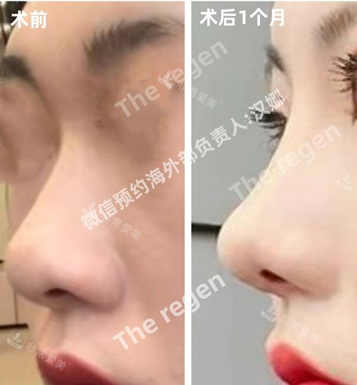鼻綜合一個月恢復(fù)程度圖片 鼻綜合一個月恢復(fù)程度圖片