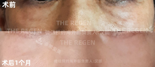 韓國JN外切去眼袋前后對比照片 韓國JN外切去眼袋前后對比照片