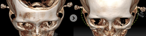 颧骨整形前后变化图