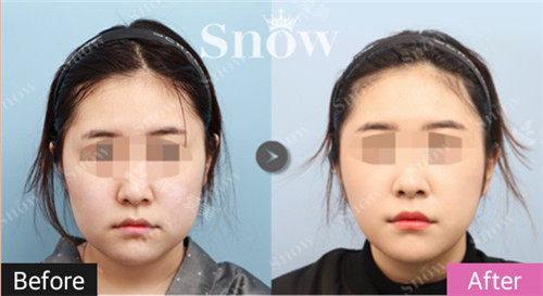 韩国snow整形面部吸脂照片