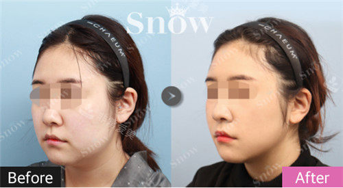 韩国snow整形面部吸脂术后照片