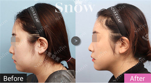 韩国snow吸脂术后图片