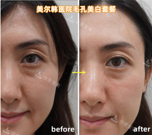 韓國美爾韓醫(yī)院皮膚管理前后圖片 韓國美爾韓醫(yī)院皮膚管理前后圖片