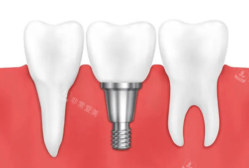 种植牙示意图