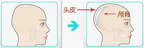 后腦勺填充位置