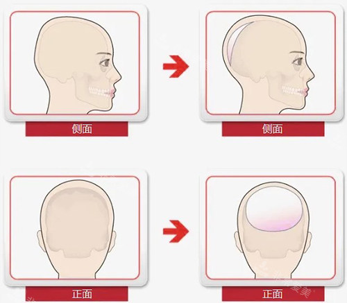 后脑勺填充示意图