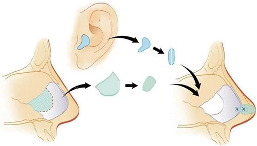 自体软骨隆鼻
