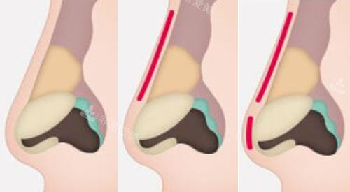 韩国秀美颜整形鼻修复手术步骤