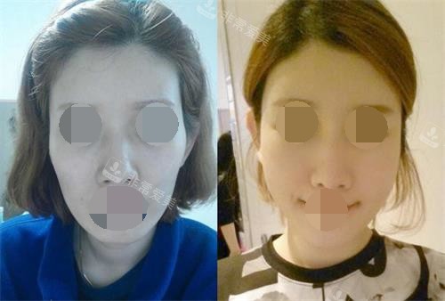 韓國貝緹萊茵整形面部填充示意圖