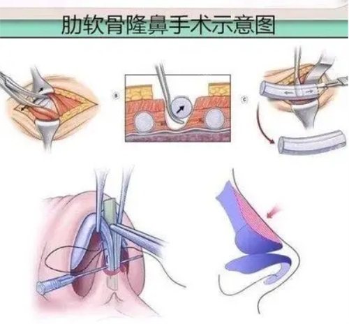 肋骨隆鼻手术示意图