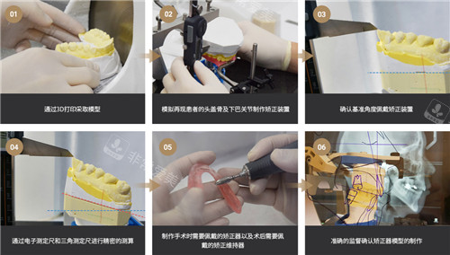 韓國EU頜面輪廓整形牙齒矯治器制作過程圖 韓國EU頜面輪廓整形牙齒矯治器制作過程圖
