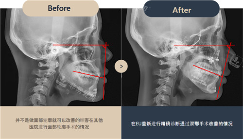 韩国EU颌面轮廓整形双鄂手术