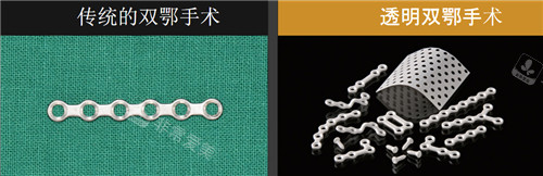 韓國EU頜面輪廓整形透明雙鄂手術(shù)對比傳統(tǒng)雙鄂手術(shù) 韓國EU頜面輪廓整形透明雙鄂手術(shù)對比傳統(tǒng)雙鄂手術(shù)