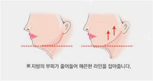 韩国芙莱思整形医院瘦脸意图 韩国芙莱思整形医院瘦脸意图