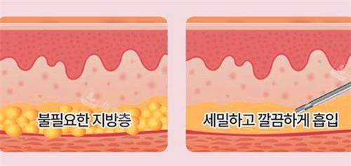 韩国芙莱思整形医院吸脂示意图 韩国芙莱思整形医院吸脂示意图