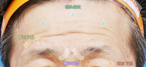 額頭提升術(shù)分區(qū)標(biāo)注圖示 額頭提升術(shù)分區(qū)標(biāo)注圖示