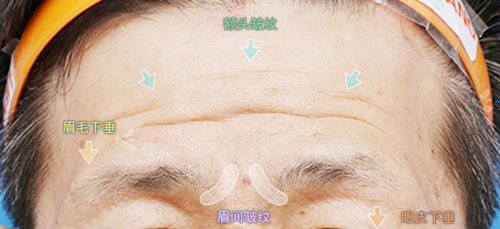 额头提升术分区标注图示