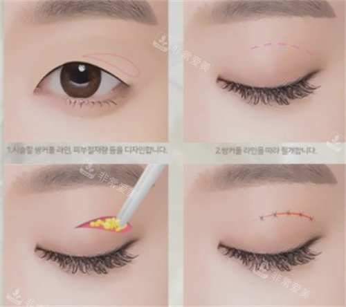 韩国双眼皮过程图