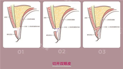 切开双眼皮手术方式介绍