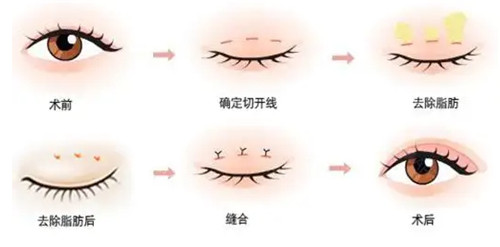 切开双眼皮手术过程图