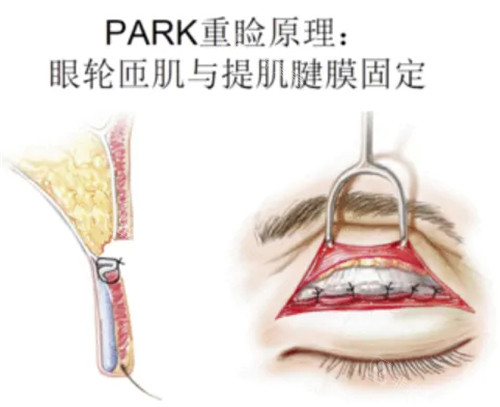 Park双眼皮原理图