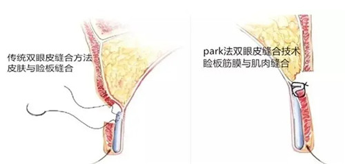 Park双眼皮与传统双眼皮手术方法区别