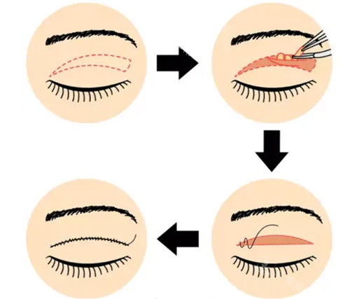 全切双眼皮手术方式