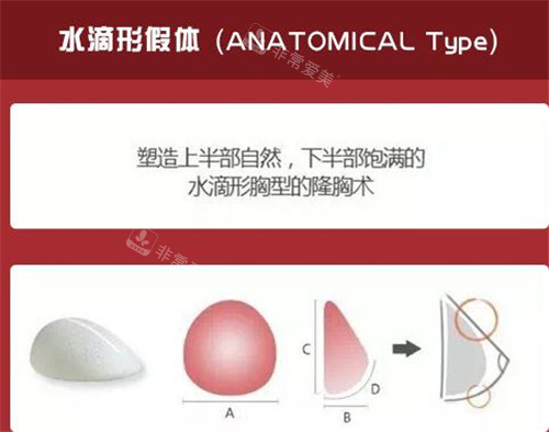 水滴型豐胸假體示意圖 水滴型豐胸假體示意圖