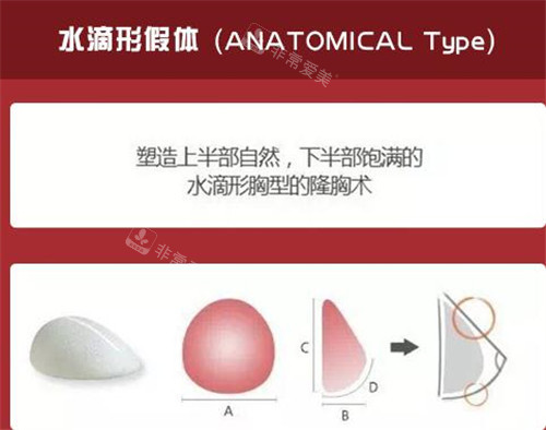 水滴型豐胸假體示意圖