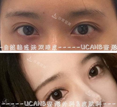 韩国UcanB整形外科眼修复改善