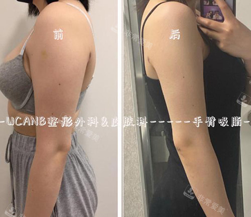 韓國UcanB整形外科手臂吸脂 韓國UcanB整形外科手臂吸脂