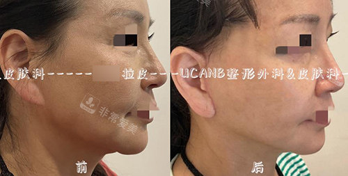 韓國UcanB整形外科面部大拉皮前后 韓國UcanB整形外科面部大拉皮前后