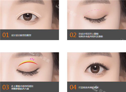 上瞼提肌手術(shù)方法示意圖 上瞼提肌手術(shù)方法示意圖