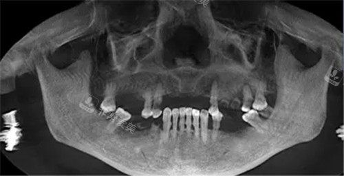 多颗牙齿缺失口腔ct照片