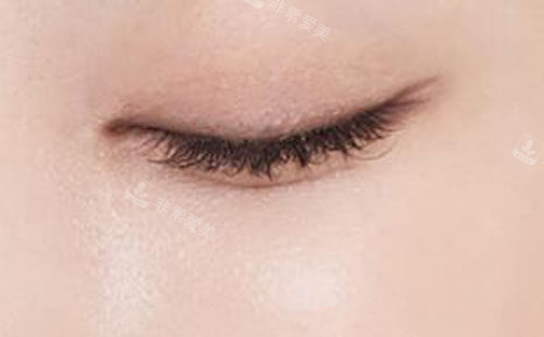 韩国秀美颜整形外科双眼皮修复形态展示