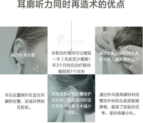 韩国普罗菲耳整形医院耳再造技术优势介绍