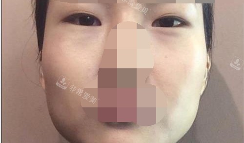 来自韩国贝缇莱茵整形医院爱美女孩经历分享 可谓改头换面