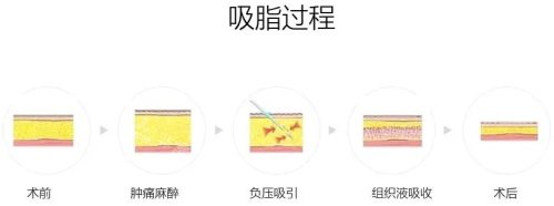 吸脂手術(shù)過程圖 吸脂手術(shù)過程圖