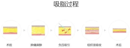 吸脂手術(shù)過(guò)程圖