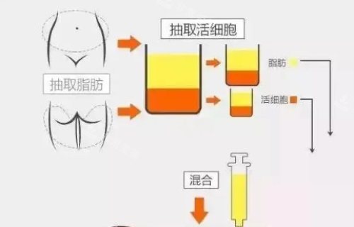 脂肪填充示意图