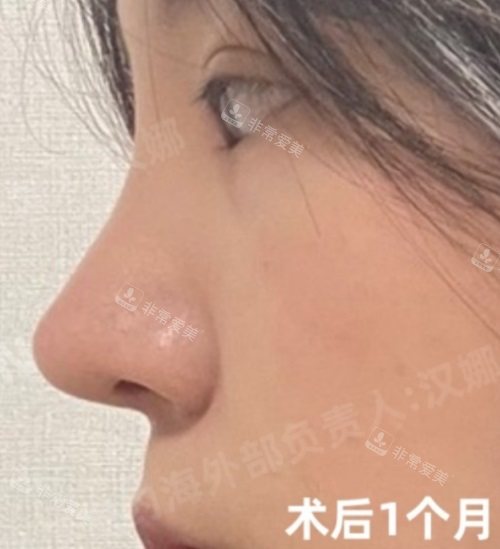 術(shù)后1個(gè)月 術(shù)后1個(gè)月